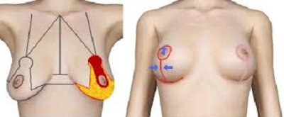 hematome reduction mammaire