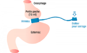 anneau gastrique est il reversible